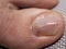 Nail infections caused by fungi such as: onychomycosis caused by dermatophytes and yeasts and for the concomitant antibacterial