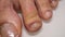Nail infections caused by fungi such as: onychomycosis caused by dermatophytes and yeasts and for the concomitant antibacterial