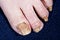 Nails affected human foot fungus, coarsely