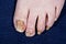 Nails feet person affected by fungus