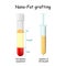 Nano-Fat grafting. test tube with Fat injection suspension. syringe with Injection of the fat graft