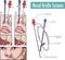 A nasal bridle attaching a nasogastric tube to the nasal septum to prevent accidental pullout