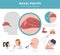 Nasal diseases. Nasal polyps causes, diagnosis and treatment medical infographic design