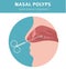 Nasal diseases. Nasal polyps causes, diagnosis and treatment medical infographic design