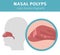 Nasal diseases. Nasal polyps causes, diagnosis and treatment medical infographic design