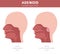 Nasal and throat, nasopharynx diseases. Adenoids diagnosis and treatment medical infographic design