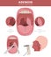 Nasal and throat, nasopharynx diseases. Adenoids diagnosis and treatment medical infographic design