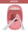 Nasal and throat, nasopharynx diseases. Adenoids diagnosis and treatment medical infographic design