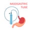 Nasogastric feeding system tube passed to stomach