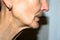 Nasolabial wrinkles. Wrinkles on the skin of the face of the neck. Flabby cheeks and neck