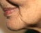 Nasolabial wrinkles. Wrinkles on the skin of the face of the neck. Flabby cheeks and neck