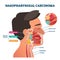 Nasopharyngeal carcinoma tumor, vector illustration