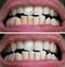 Natural Teeth Bleaching, Teeth Before And After Whitening, Dental Care and Treatment Process