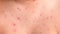 NChicken pox rash