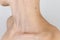 Neck, shoulder and collarbone of a young girl with a lot of moles, concept of skin care, beauty and cancer risks due to