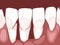 Necrotizing ulcerative gingivitis is a periodontal diseases