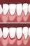 Necrotizing ulcerative gingivitis is a periodontal diseases