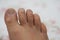 Neglected male toes, fungus toes, fungal disease, calluses on toes