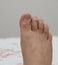 Neglected male toes, fungus toes, fungal disease, calluses on toes