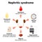 Nephritic syndrome