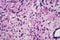 A neurofibroma tissue sample in neurofibromatosis genetic disease, light micrograph