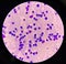 Neutrophil in synovial fluid inframatory cells