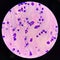 Neutrophil in synovial fluid inframatory cells