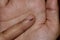 Nevus on finger of Asian woman