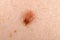 Nevus on human skin