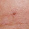 Nevus or mole on the human body close-up. Skin cancer, keratosis or melanoma on the skin