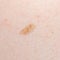 Nevus or mole on the human body close-up. Skin cancer, keratosis or melanoma on the skin