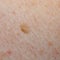 Nevus or mole on the human body closeup. Skin cancer, keratosis or melanoma on the skin