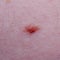 Nevus or mole on the skin of adult
