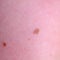 Nevus or mole on the skin of adult