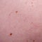 Nevus or mole on the skin of adult