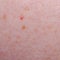 Nevus or mole on the skin of adult