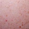 Nevus or mole on the skin of adult