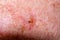 Nevus or papilloma or mole or melanoma or keratosis on the skin of adult