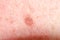 Nevus or papilloma or mole or melanoma or keratosis on the skin of adult