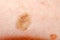 Nevus or papilloma or mole or melanoma or keratosis on the skin of an adult