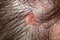 Nevus sebaceus on scalp