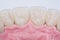 New white ceramic dentures on a light background