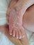 Newborn baby feet with flaky dry skin. Infant after born with very dry, wrinkled, cracked skin on foot