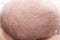 Newborn head with cradle cap