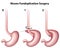 Nissen Fundoplication Surgery