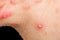 Nodular cystic acne skin