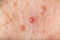 Nodular cystic acne skin