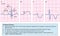 Normal and abnormal ecg traces