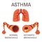 Normal and asthmatic bronchioles