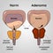 Normal bladder and BPH problem, prostate adenoma medical vector illustration